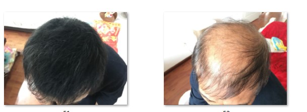 掉头发是什么原因引起的脱发,额头脱发的原因和治疗方法