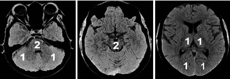 2017急性缺血性卒中血管内治疗影像评估中国行家共识