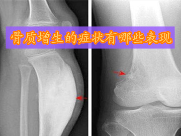 腰椎骨质增生是什么症状怎么治疗,颈椎骨质增生有哪些症状如何治疗