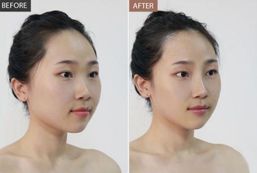 膨体隆鼻和硅胶哪个更好,膨体和硅胶哪种隆鼻最安全永久