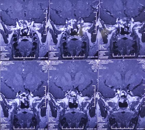 脑膜膨出手术是用什么修补的,蝶鞍区脑膜膨出手术怎么做