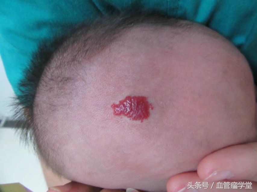 口服普萘洛尔治疗血管瘤的副功能,普萘洛尔口服液能治疗血管瘤吗