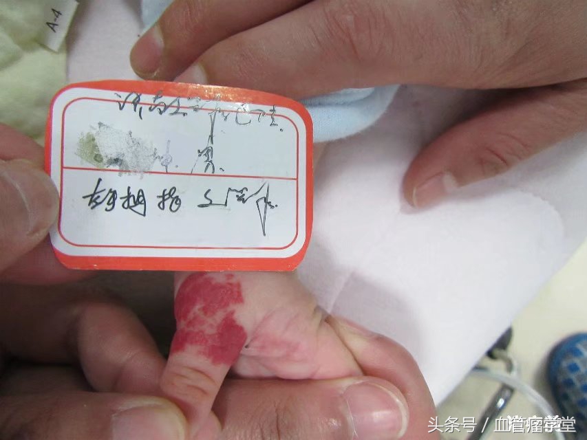 口服普萘洛尔治疗血管瘤的副功能,普萘洛尔口服液能治疗血管瘤吗