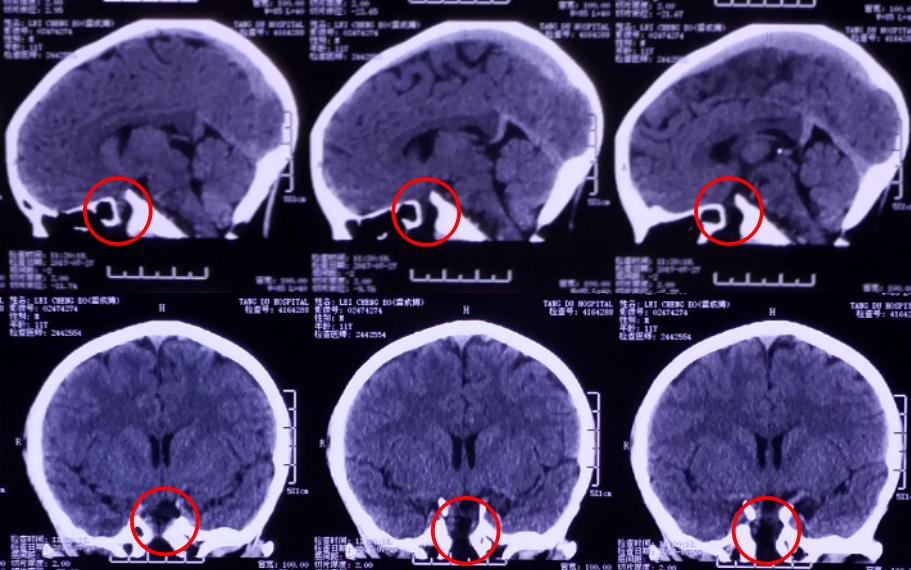 脑膜膨出手术是用什么修补的,蝶鞍区脑膜膨出手术怎么做