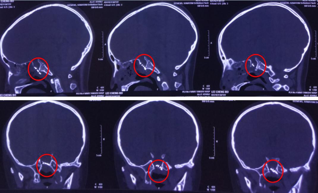 脑膜膨出手术是用什么修补的,蝶鞍区脑膜膨出手术怎么做