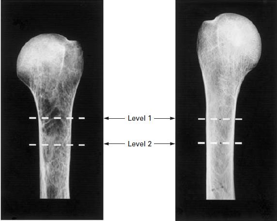肱骨近端骨折内固定康复动作,肱骨近端骨折关节置换