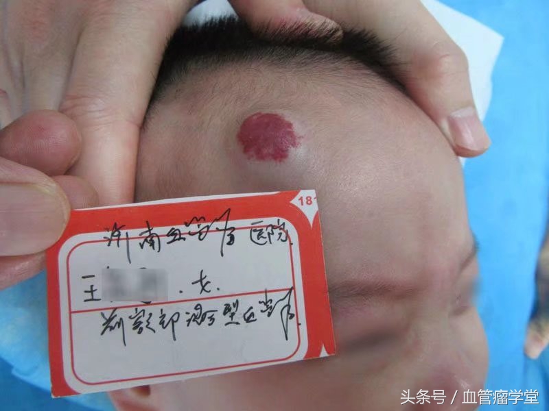 口服普萘洛尔治疗血管瘤的副功能,普萘洛尔口服液能治疗血管瘤吗