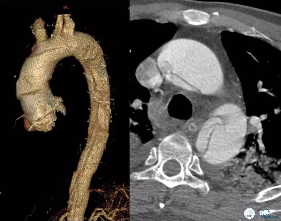 主动脉夹层引起的脑梗后遗症,颈动脉狭窄缺血性脑梗