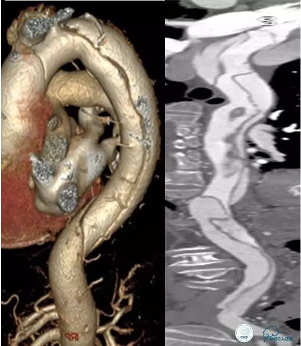 主动脉夹层引起的脑梗后遗症,颈动脉狭窄缺血性脑梗