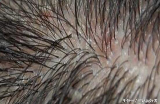 脂溢性脱发治疗初期脱发更严重,慢性脂溢性脱发用什么药
