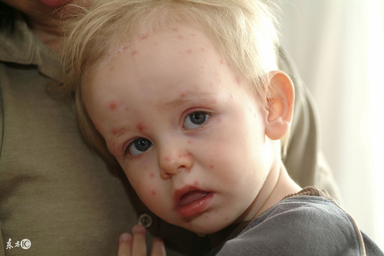 春季小孩易得什么传染病,夏季幼儿易得传染病