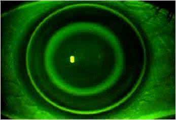 近视眼100度能够矫正吗,眼睛近视还有矫正的必要吗