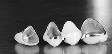 细说烤瓷牙的那些事,一篇文章让你充分了解烤瓷牙