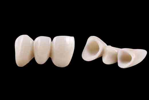 细说烤瓷牙的那些事,一篇文章让你充分了解烤瓷牙