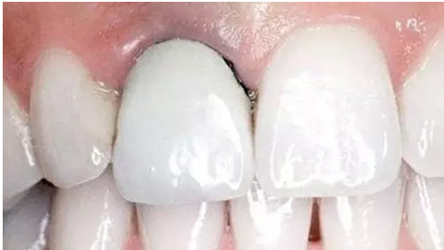 细说烤瓷牙的那些事,一篇文章让你充分了解烤瓷牙