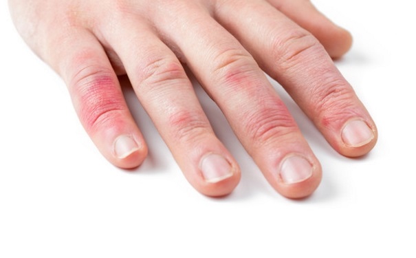 防止冻疮最好的方法,防止冻疮的最好办法