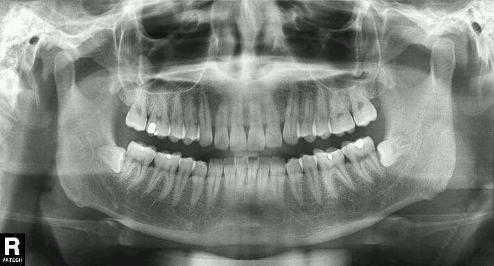 智齿长歪了把邻牙挤坏了,智齿挤歪了会自己恢复吗