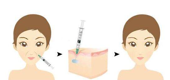 纹法令纹最有效办法,有法令纹怎么去消法令纹