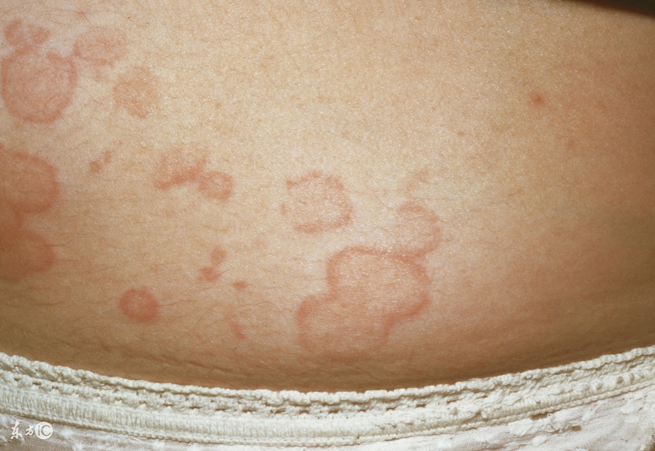 丘疹性荨麻疹能够打麻疹疫苗吗,丘疹性荨麻疹和麻疹应该怎么区分