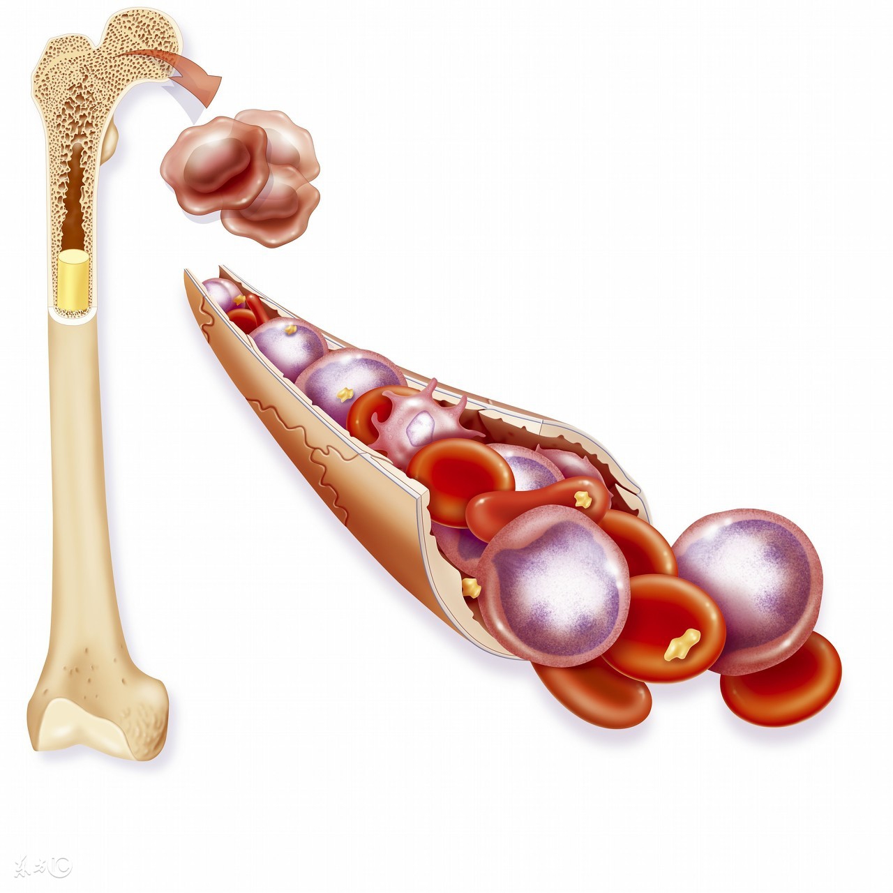 缺铁会导致宝宝白血病吗,缺铁性贫血会得白血病吗