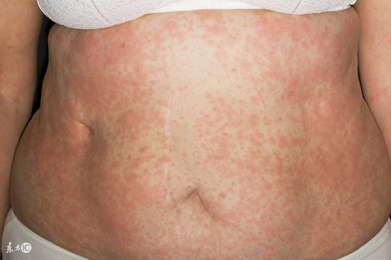 丘疹性荨麻疹能够打麻疹疫苗吗,丘疹性荨麻疹和麻疹应该怎么区分