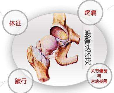 股骨头坏死想恢复血供怎么锻炼,股骨头坏死通过锻炼能恢复吗