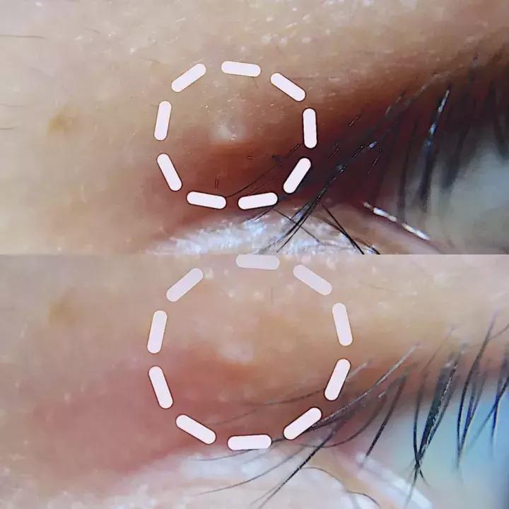 眼霜抗皱去细纹黑眼圈脂肪粒,眼霜推荐去细纹黑眼圈眼袋油脂粒