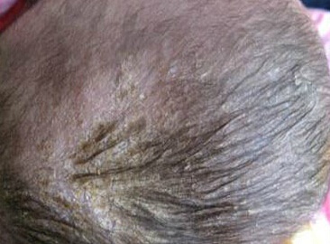 脂溢性皮炎用什么洗面奶,脂溢性皮炎用什么洗发水