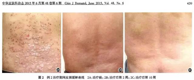 银屑病生物制剂可善挺要打多少针,银屑病生物制剂的效果如何