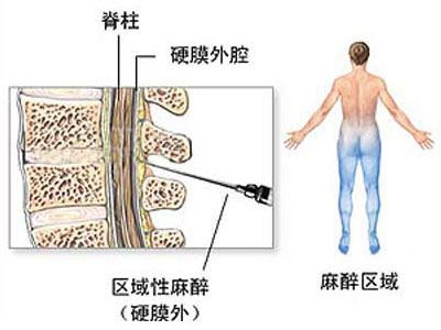 剖腹产全过程,剖腹产20天伤口真实照片