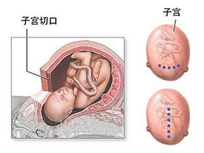 剖腹产全过程,剖腹产20天伤口真实照片