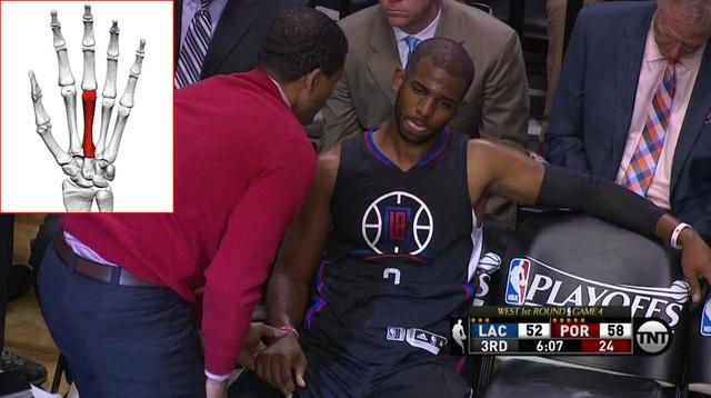 保罗手指骨折火箭比赛,保罗骨折