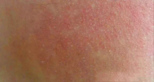 酒渣鼻怎么改善学生党,酒渣鼻严重怎么彻底治疗