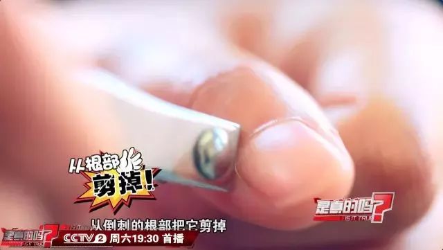 「涨姿势」随手一撕倒刺，她手指肿成萝卜！看完还敢手欠吗？