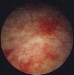 高压氧舱治疗膀胱炎尿血吗,高压氧对慢性肾病有功能吗