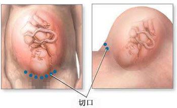 剖腹产全过程,剖腹产20天伤口真实照片