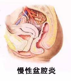 女性腹痛警惕五种病,女人腹痛怎么回事怎么缓解