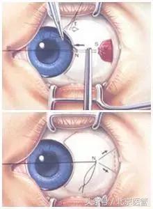 小孩歪头会导致眼睛斜视吗,儿童眼睛斜视眯着眼怎么造成的