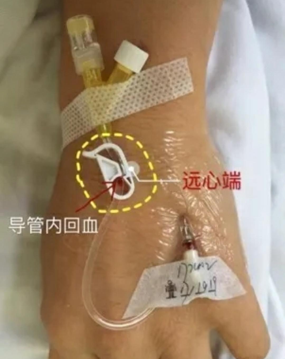 套管针的使用方法和保存方法,怎么让套管针回血