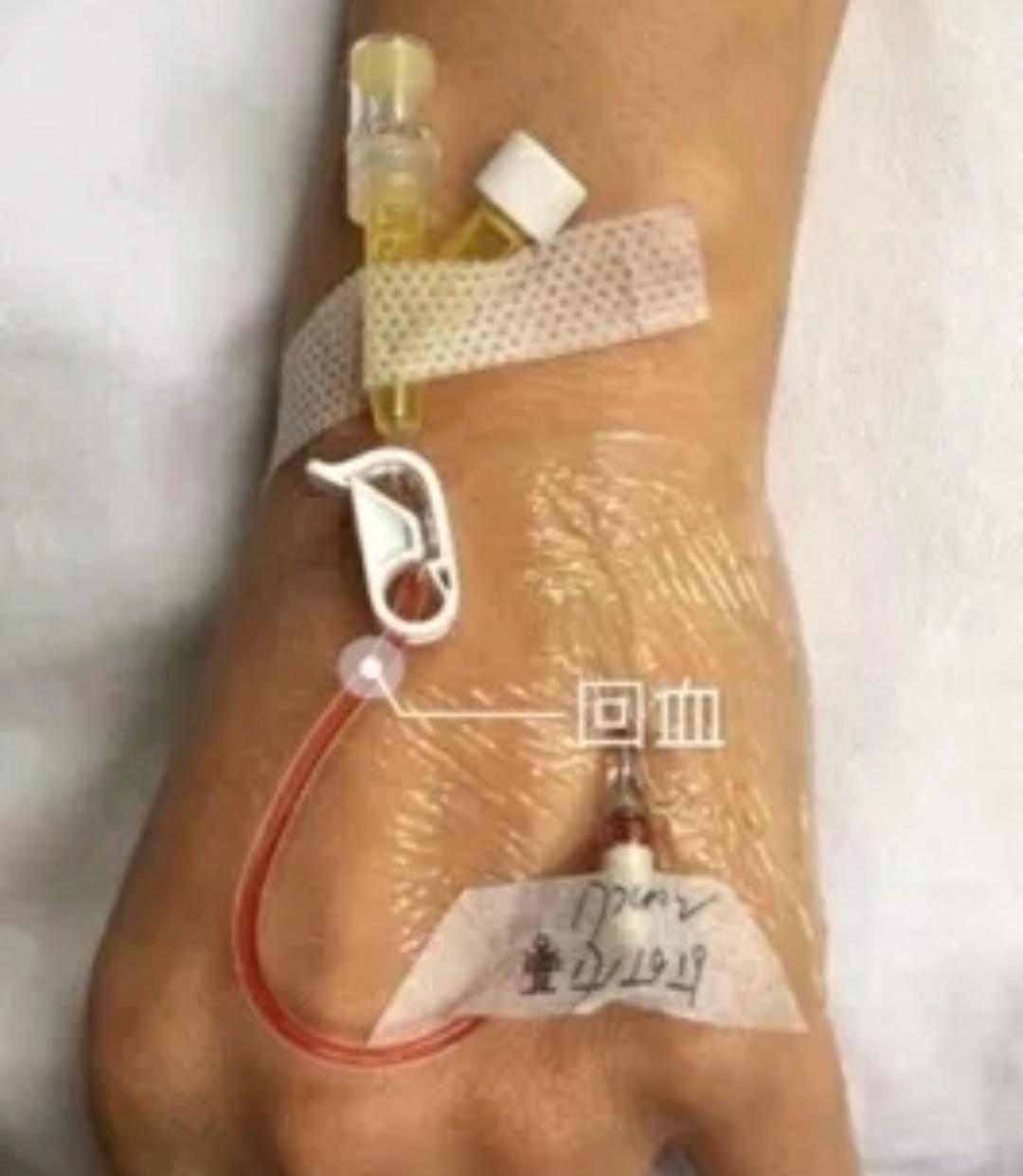 套管针的使用方法和保存方法,怎么让套管针回血