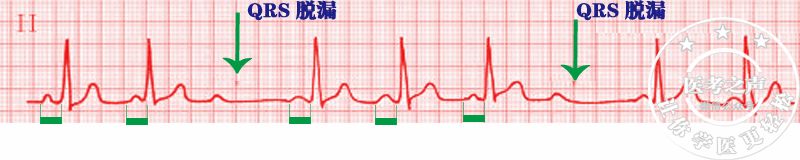 心电图秒懂,心电图零基础都秒懂
