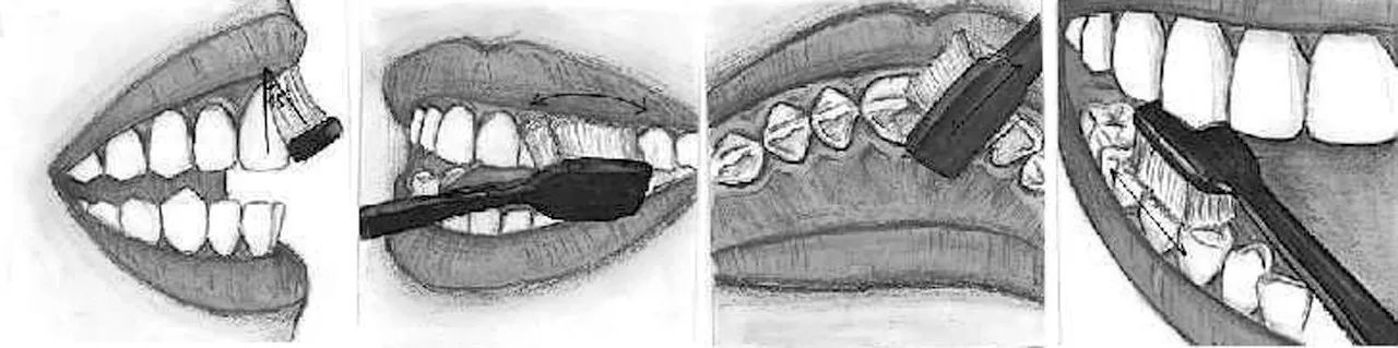 牙上有斑怎么去除,牙斑怎么去除最有效的方法