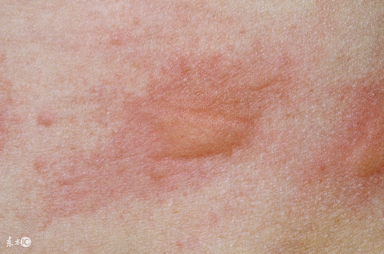 丘疹性荨麻疹的症状有什么,丘疹性荨麻疹有什么症状和感觉