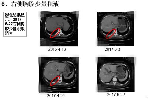 肺鳞癌能用nk细胞疗法吗,肺腺癌nkt治疗告捷案例