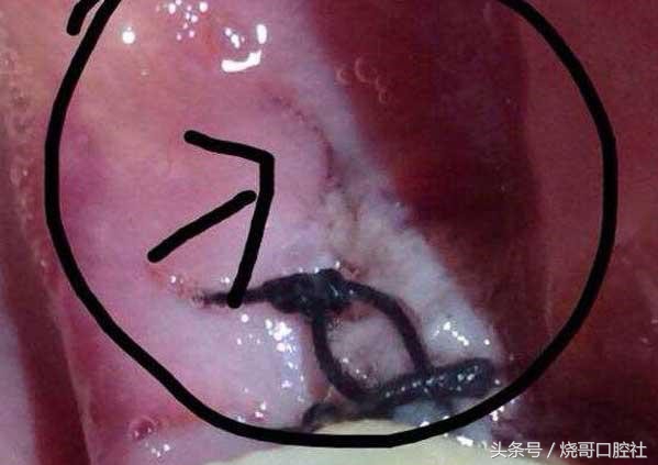 拔牙之后能够不拆线吗,拔牙后不拆线有影响吗