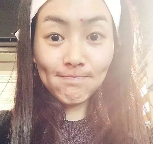 郑爽屏幕前貌美如花，幕后满脸痘花，明星都被坑的痘痘该怎么治？