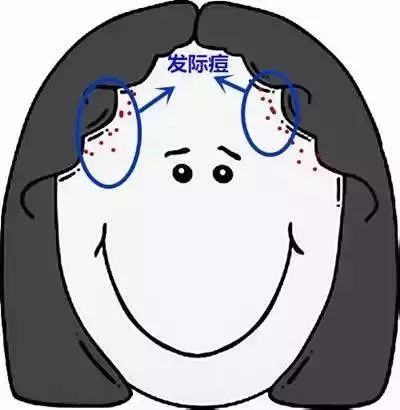 郑爽屏幕前貌美如花，幕后满脸痘花，明星都被坑的痘痘该怎么治？