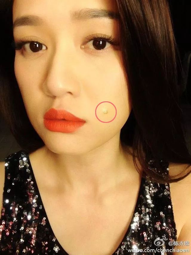 郑爽屏幕前貌美如花，幕后满脸痘花，明星都被坑的痘痘该怎么治？