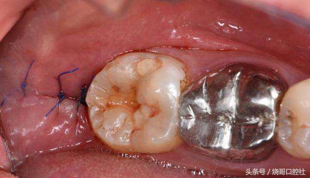 拔牙之后能够不拆线吗,拔牙后不拆线有影响吗