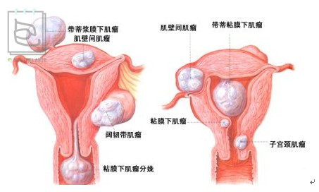 北美红宝石蔓越莓,北美红宝石蔓越莓干